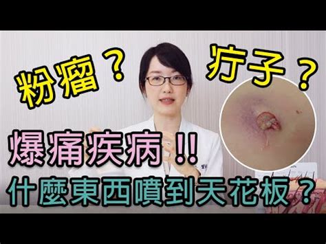 臉上釘子|「長釘子」別亂擠！疔瘡是什麼？會自己好嗎？原因及治療方法一。